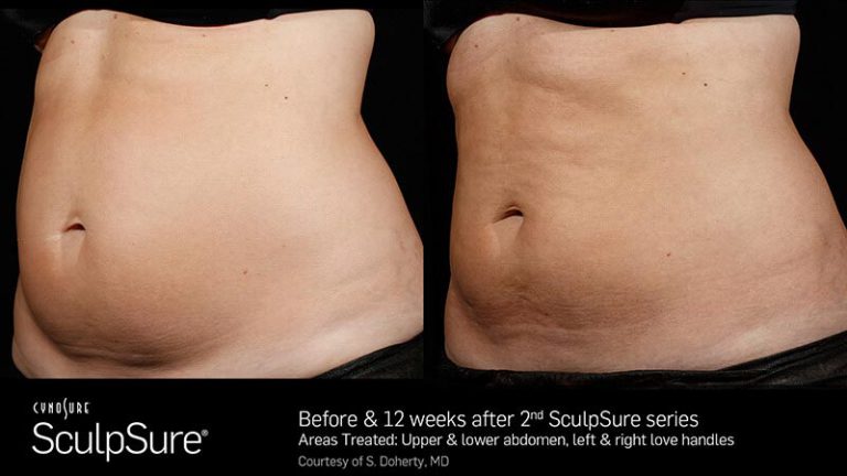 Before and after SculpSure