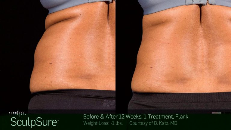 5 Reasons Why Body Sculpting with SculpSure Remains So Popular - Elkins  Park Family Medicine